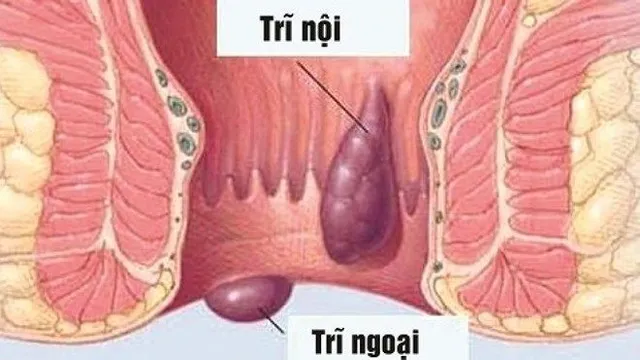 Nguyên nhân và cách phòng ngừa bệnh trĩ - Ảnh 1.