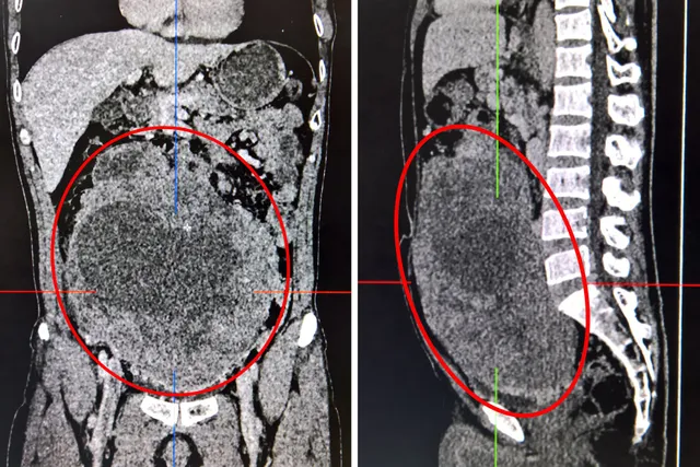 Người đàn ông bụng ngày mỗi to do khối u khổng lồ chiếm trọn ổ bụng - Ảnh 1.