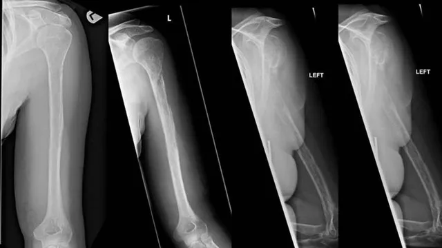 Mối nguy từ bệnh xương tự tiêu - Ảnh 1. Mối nguy từ bệnh xương tự tiêu - Ảnh 1.