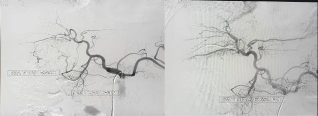 Nút mạch u gan vỡ cứu du khách nước ngoài thoát cửa tử - Ảnh 1.