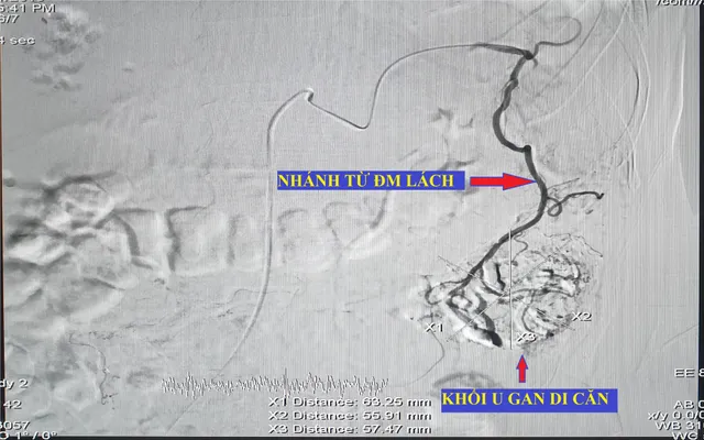 Lần đầu tiên can thiệp thành công ung thư gan di căn bằng nút động mạch hóa chất tại Đồng Bằng Sông Cửu Long - Ảnh 1.