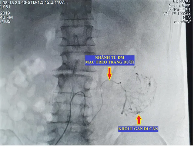 Lần đầu tiên can thiệp thành công ung thư gan di căn bằng nút động mạch hóa chất tại Đồng Bằng Sông Cửu Long - Ảnh 2.