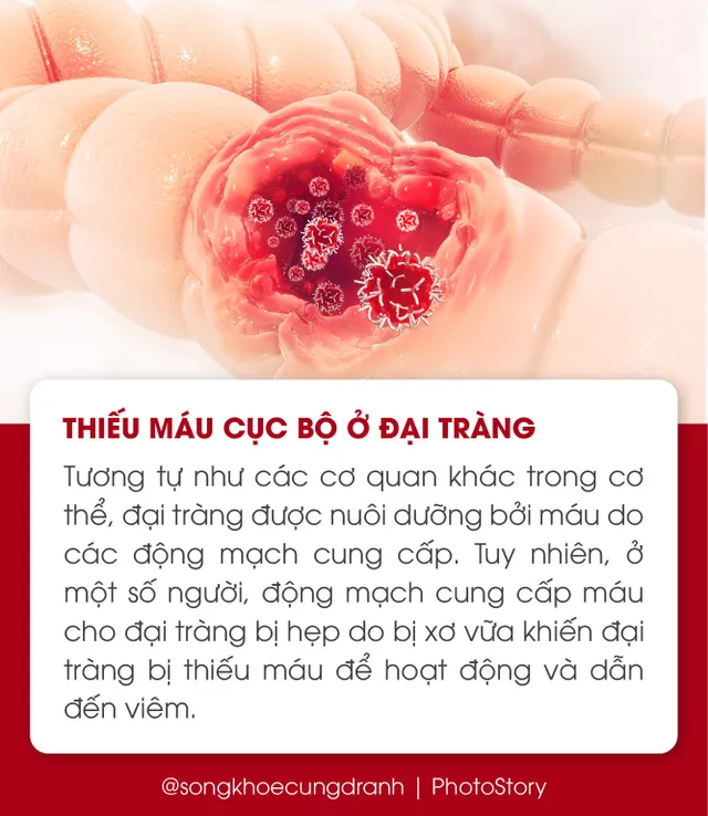 5 nguyên nhân phổ biến gây viêm đại tràng - Ảnh 3.