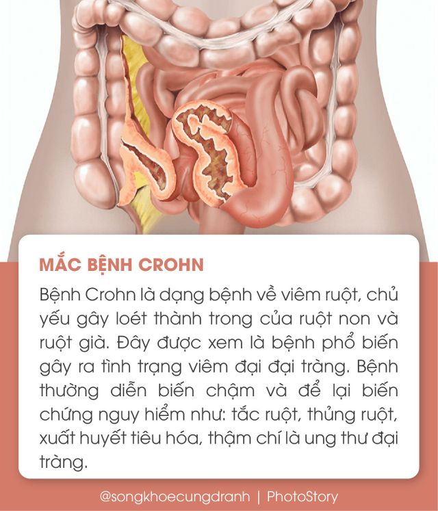 5 nguyên nhân phổ biến gây viêm đại tràng - Ảnh 4.