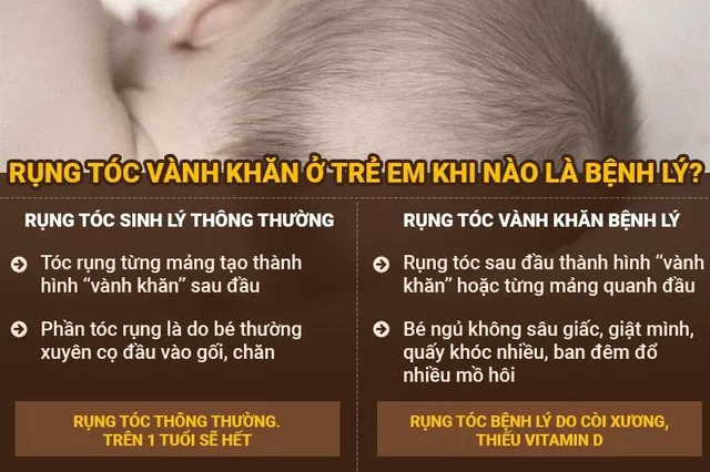 Rụng tóc vành khăn ở trẻ sơ sinh có phải là bệnh lý? Điều trị ra sao? - Ảnh 1.