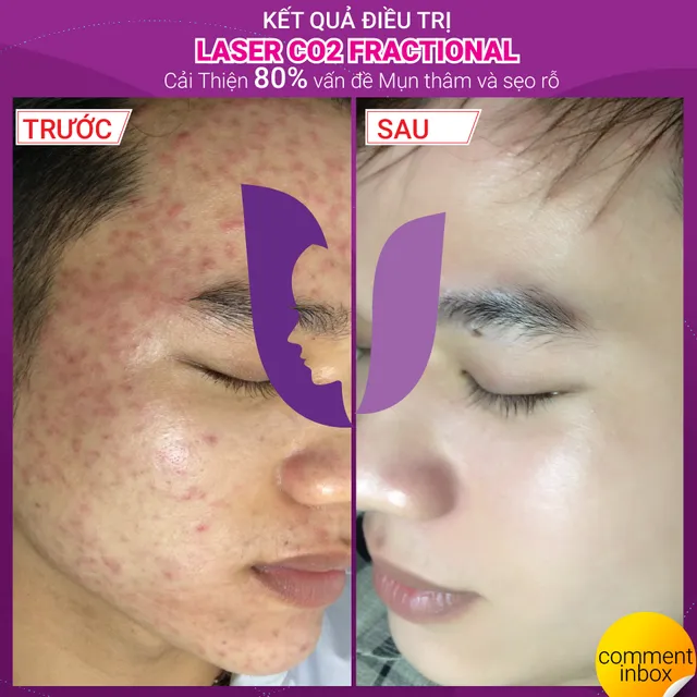 Muốn đẹp lên thì trước hết hãy tiêu diệt hết kẻ thù không đội trời chung: Mụn! - Ảnh 1. Muốn đẹp lên thì trước hết hãy tiêu diệt hết kẻ thù không đội trời chung: Mụn! - Ảnh 1.