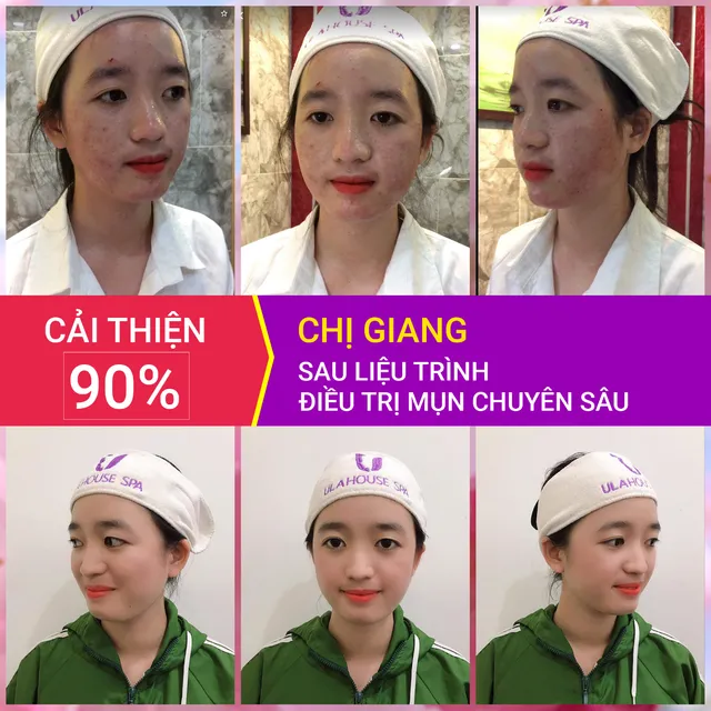 Muốn đẹp lên thì trước hết hãy tiêu diệt hết kẻ thù không đội trời chung: Mụn! - Ảnh 4. Muốn đẹp lên thì trước hết hãy tiêu diệt hết kẻ thù không đội trời chung: Mụn! - Ảnh 4.