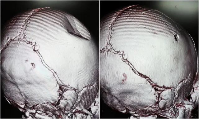 Phẫu thuật thành công cứu bé 3 tháng tuổi bị gạch rơi lún sọ - Ảnh 1.