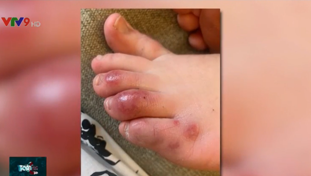 “Ngón chân Covid”: Triệu chứng lạ ở bệnh nhân nhiễm virus SARS-CoV-2 - Ảnh 1.