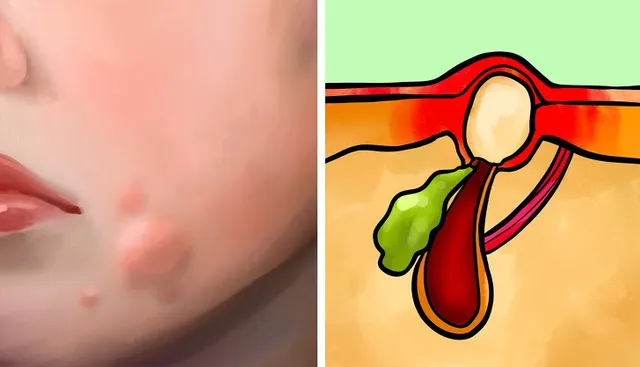 Tất tần tật về 6 loại mụn mà ai cũng gặp - Ảnh 6.