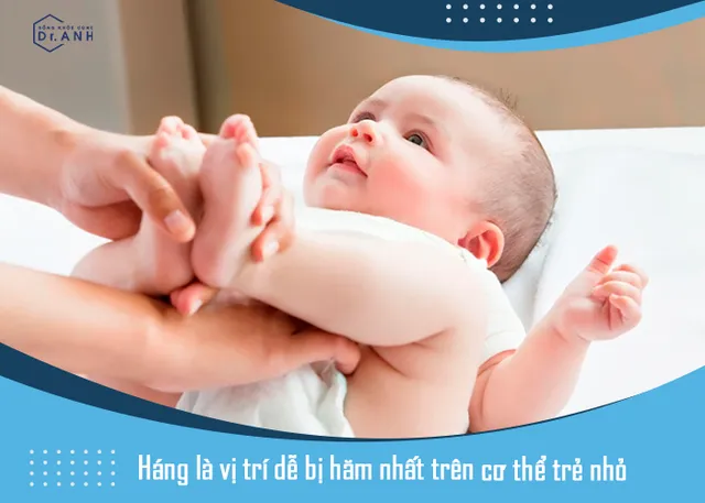 Bỏ túi mẹo trị hăm siêu đơn giản dành cho bé yêu - Ảnh 1.