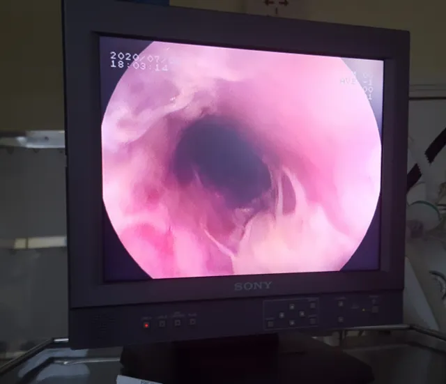 Bé 6 tuổi bong tróc niêm mạc thực quản do uống phải nước làm bánh tro - Ảnh 2. Bé 6 tuổi bong tróc niêm mạc thực quản do uống phải nước làm bánh tro - Ảnh 2.
