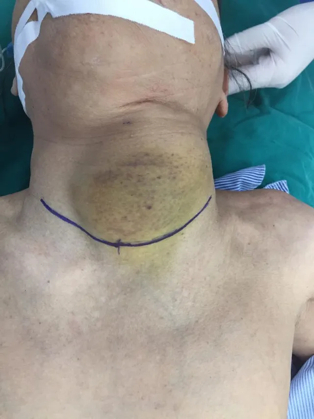 Suốt 10 năm sống cùng khối bướu cổ khổng lồ - Ảnh 1. Suốt 10 năm sống cùng khối bướu cổ khổng lồ - Ảnh 1.