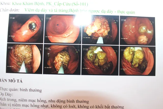 Loét dạ dày, xuất huyết tiêu hóa sau khi ăn quả bứa, uống trà sữa trân châu - Ảnh 1. Loét dạ dày, xuất huyết tiêu hóa sau khi ăn quả bứa, uống trà sữa trân châu - Ảnh 1.