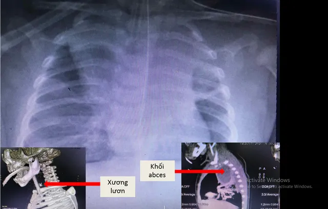 Bé 6 tháng thủng thực quản, suy hô hấp nặng do hóc xương lươn khi ăn cháo - Ảnh 1. Bé 6 tháng thủng thực quản, suy hô hấp nặng do hóc xương lươn khi ăn cháo - Ảnh 1.