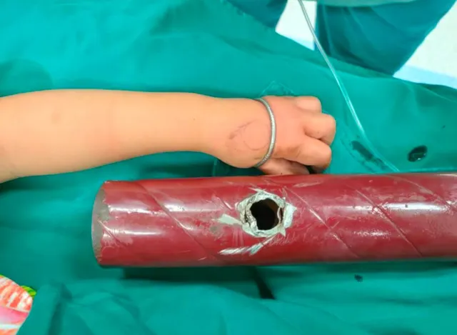 Cưa ngang chân giường, đưa bé gái 3 tuổi vào viện giải cứu - Ảnh 1. Cưa ngang chân giường, đưa bé gái 3 tuổi vào viện giải cứu - Ảnh 1.