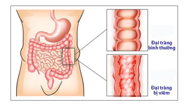 Viên sủi Almin - Giải pháp mới hiệu quả cho người viêm đại tràng - Ảnh 1.