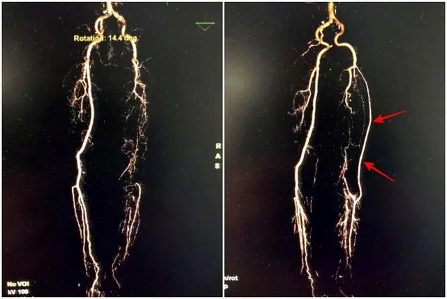 Phẫu thuật bắc cầu động mạch chi bằng tĩnh mạch tự thân dài gần 1m - Ảnh 2.