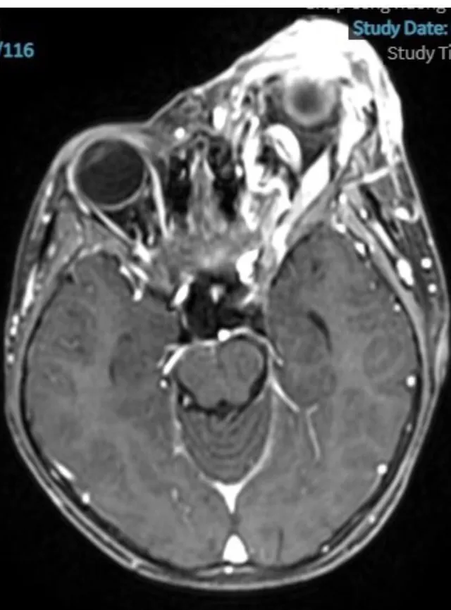 Bé trai 8 tuổi nhập viện với khối u máu lớn ở mắt - Ảnh 1.
