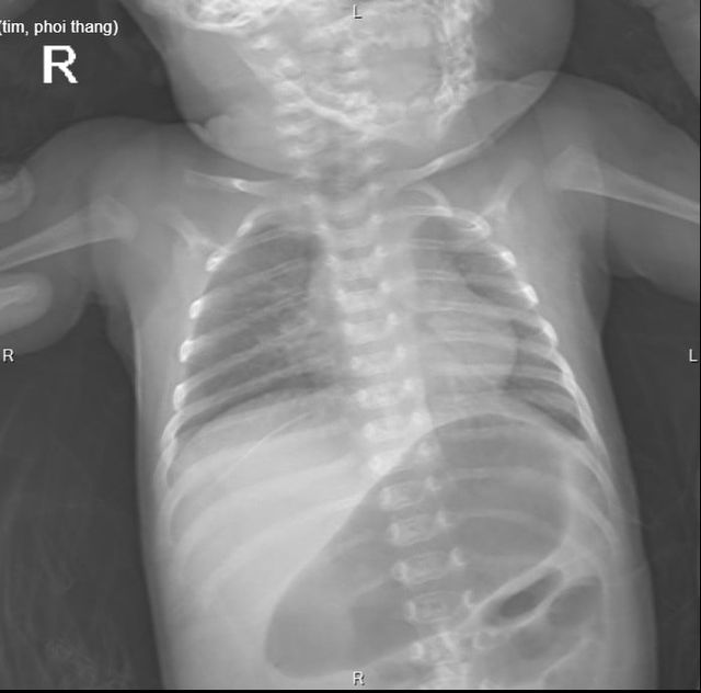 Bị thoát vị hoành trái nghẹt, toàn bộ ruột non của bé sơ sinh nằm trên khoang màng phổi - Ảnh 1.