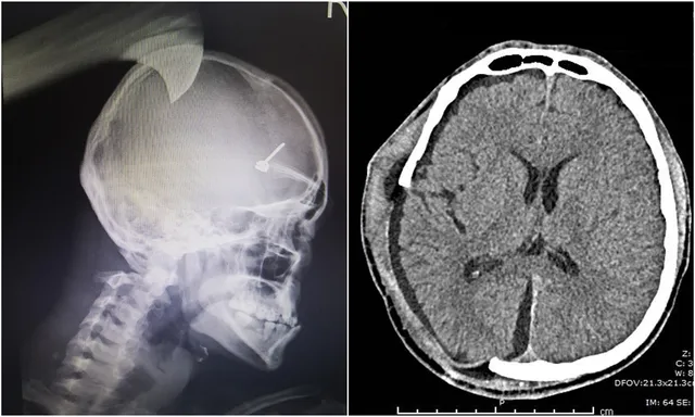 Cứu sống bệnh nhân bị dao quắm găm xuyên não - Ảnh 1.