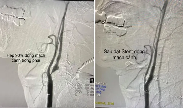 Đặt stent can thiệp bệnh nhân bị hẹp 90% động mạch cảnh - Ảnh 1.