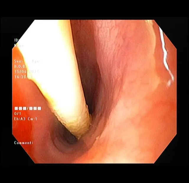 Bé trai đau bụng hơn 1 tháng, bác sĩ lấy que kẹo bằng nhựa dài 10cm trong tá tràng - Ảnh 1.