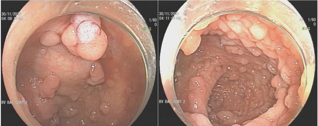 Điều trị cho bệnh nhân bị đa polyp đại trực tràng di truyền hiếm gặp - Ảnh 1.