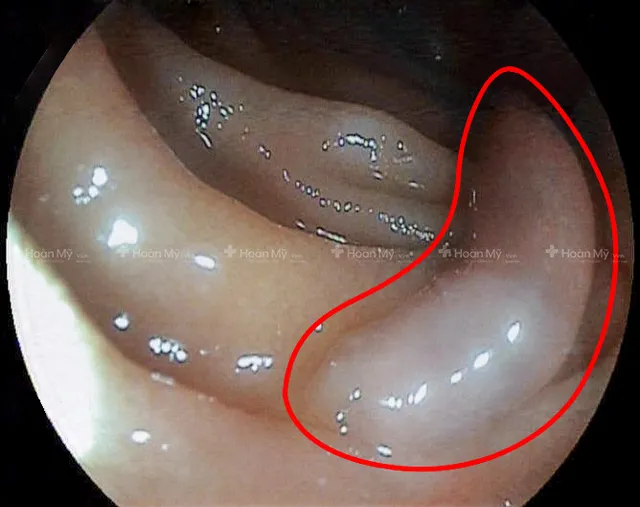 Phát hiện ổ sán lá ruột lớn trong tá tràng bệnh nhân - Ảnh 1.