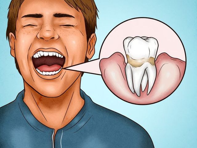 4 dấu hiệu cho thấy bạn đang đánh răng sai cách - Ảnh 4.