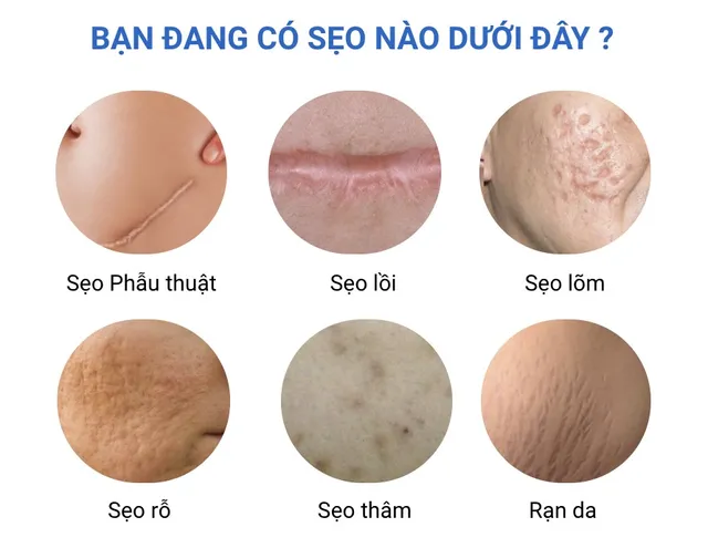 Bí quyết xử lý thâm sẹo bằng Actiscar - Ảnh 1.