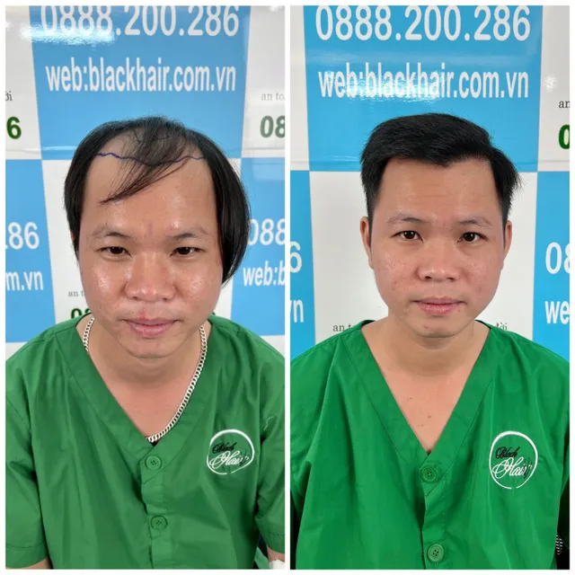 Phòng khám Black Hair đồng hành cùng bạn giải quyết nỗi lo rụng tóc, hói đầu - Ảnh 3.