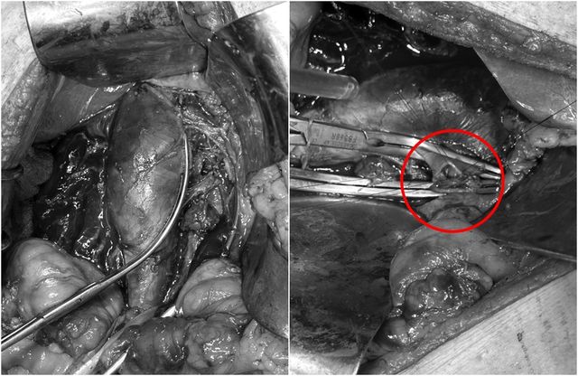 Truyền hơn 3 lít máu, mổ trong đêm cứu sống bệnh nhân vết thương xuyên động - tĩnh mạch chủ bụng - Ảnh 1.