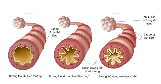 Giải pháp cải thiện ho, khò khè, khó thở - Ảnh 1.