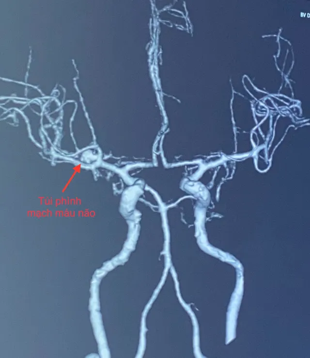 Đột ngột ngất 30 phút, vào viện kiểm tra phát hiện vỡ túi phình mạch máu não - Ảnh 1.