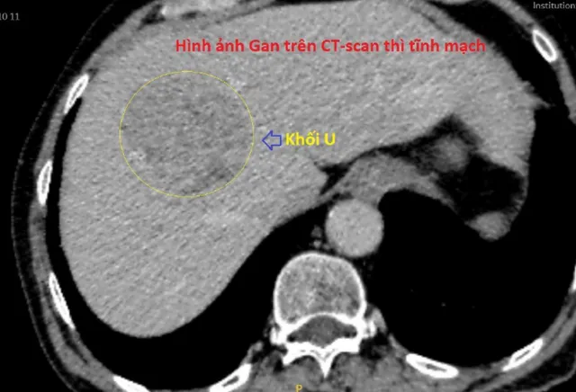 Nhập viện vì hôn mê, bác sĩ phát hiện bệnh nhân có khối u gan lớn - Ảnh 1.