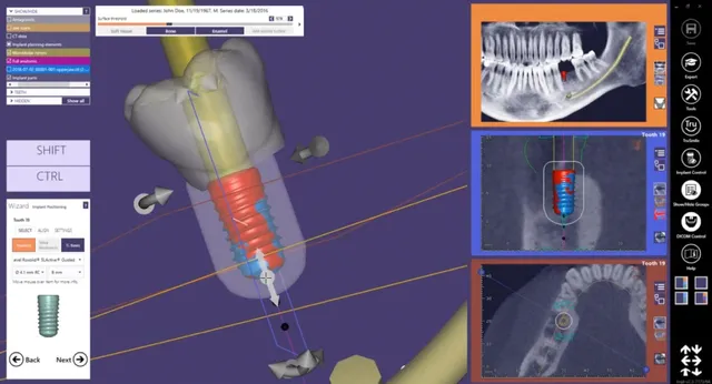 Safe-Tech: Công nghệ trồng răng Implant an toàn, không đau - Ảnh 1.