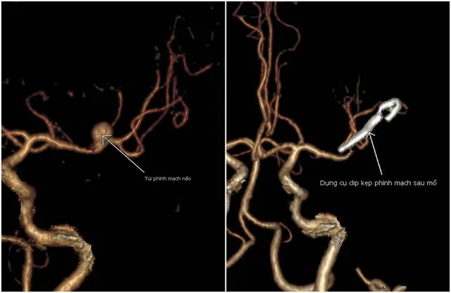 Vi phẫu lấy máu tụ nội sọ kết hợp kẹp phình mạch não cứu bệnh nhân nguy kịch - Ảnh 2.