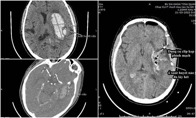 Vi phẫu lấy máu tụ nội sọ kết hợp kẹp phình mạch não cứu bệnh nhân nguy kịch - Ảnh 1.