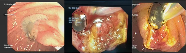 Nhiễm trùng đường mật do sán lá gan - Ảnh 1.