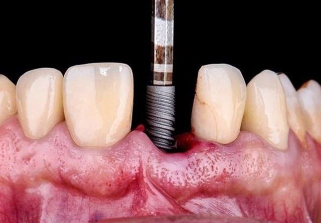 Nguy hiểm tiềm ẩn khi trồng implant giá rẻ - Ảnh 1.