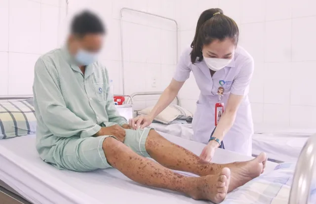 Điều trị thành công cho bệnh nhân bị ban xuất huyết Schonlein-Henoch - Ảnh 1.