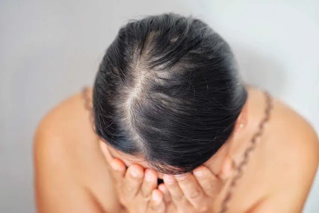 Rụng tóc sau COVID-19: Bạn có nên lo lắng? - Ảnh 4. Rụng tóc sau COVID-19: Bạn có nên lo lắng? - Ảnh 4.