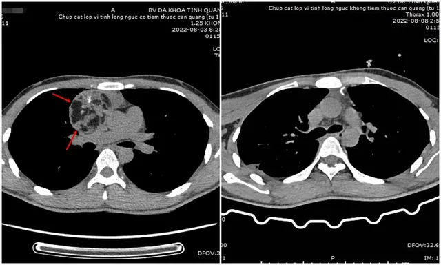 Nội soi cắt khối u quái trung thất cho bệnh nhân trẻ tuổi - Ảnh 1.