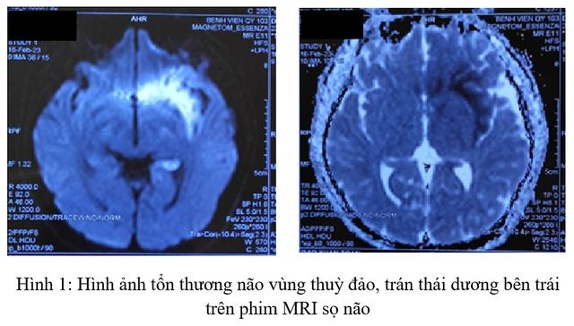 Nam thanh niên nguy kịch do viêm não - Ảnh 1.