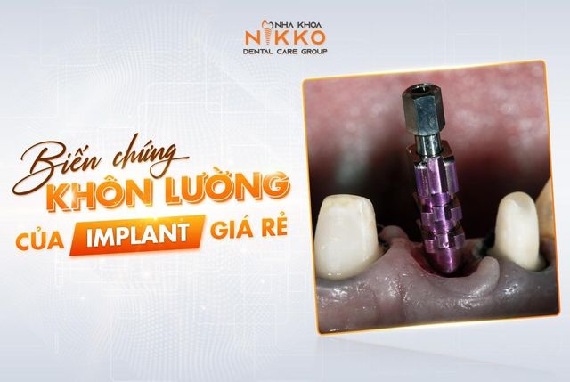 Nha khoa Nikko chỉ ra nguy hại khôn lường của implant giá rẻ - Ảnh 1.