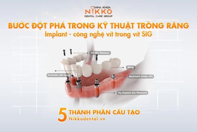 Nha khoa Nikko chỉ ra nguy hại khôn lường của implant giá rẻ - Ảnh 3.