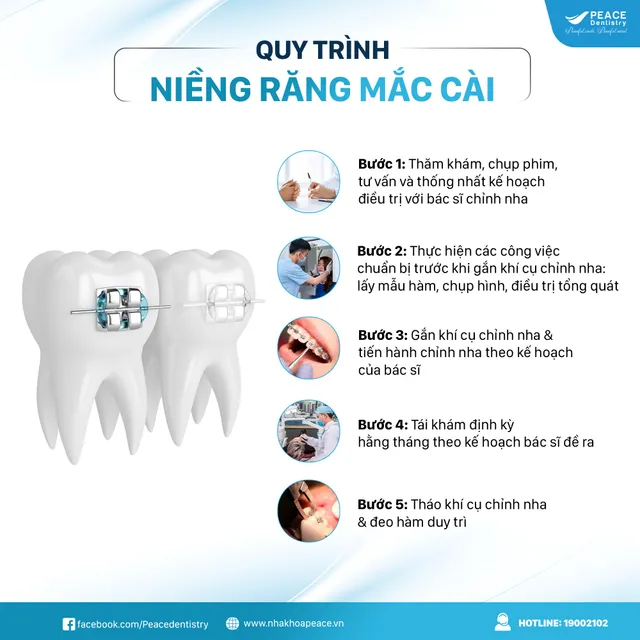 Nha khoa Peace Dentistry lưu ý về độ tuổi niềng răng phù hợp - Ảnh 1.