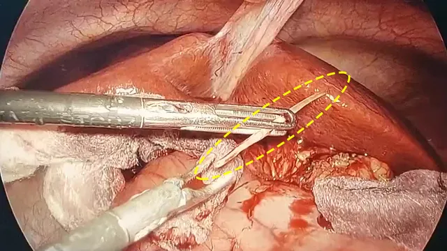 Suýt mất mạng do nuốt xương cá mà không hay biết - Ảnh 1.