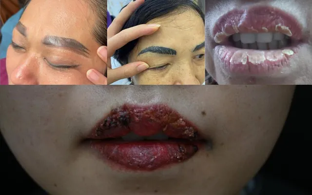 Rủi ro trong phun xăm thẩm mỹ: Đâu là giải pháp khắc phục an toàn và hiệu quả?